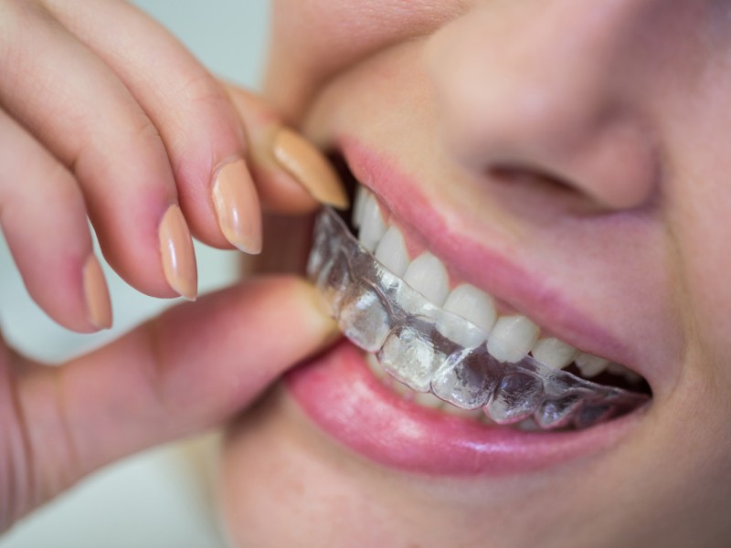 יישור שיניים קשתיות שקופות מגבלות