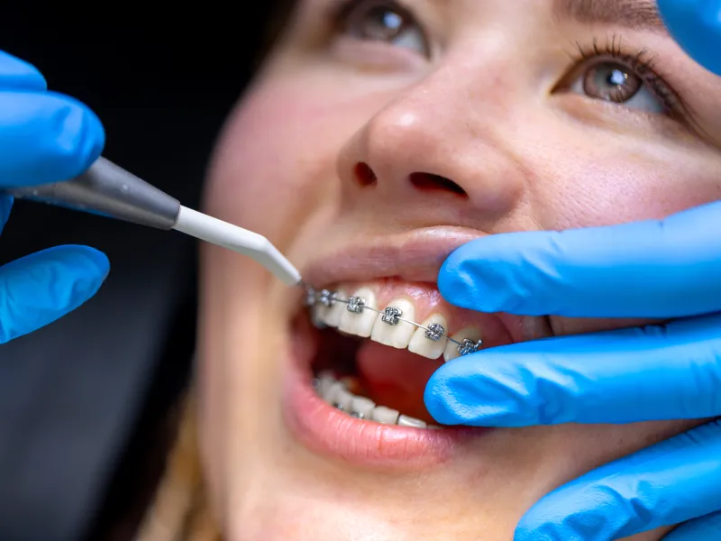 יישור שיניים בכפר סבא