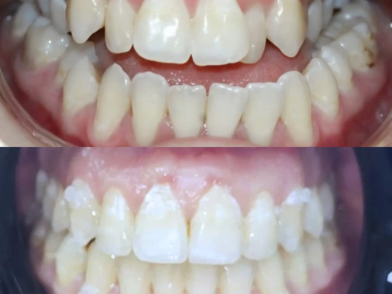 יישור שיניים משנה את החיים