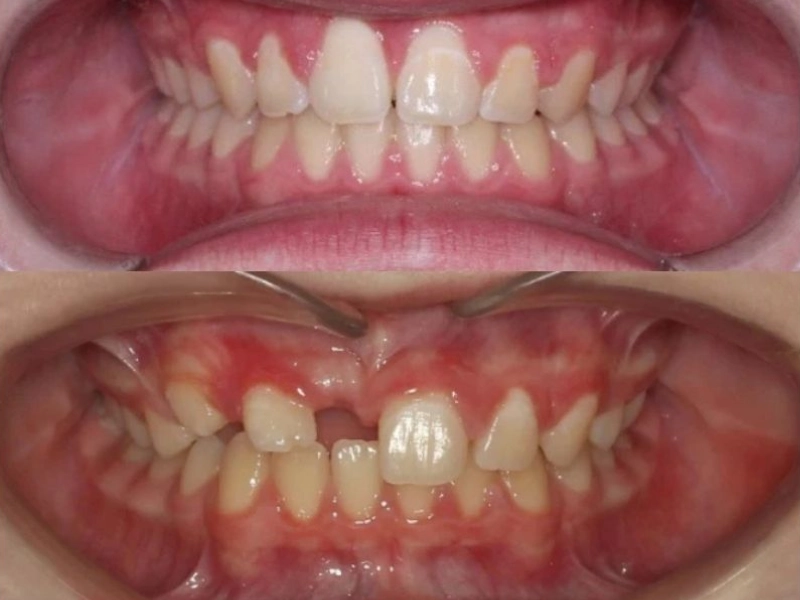 מקרה מורכב של שן 11