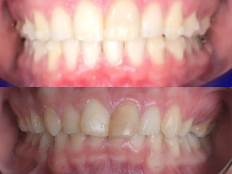 מקרה יישור שיניים מורכב